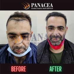 Top 5 Hair Transplant Before and After Result in Delhi